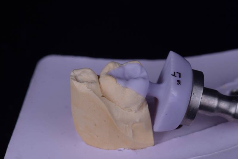 Procédure par un dentiste : Inlay-onlay en céramique E.max